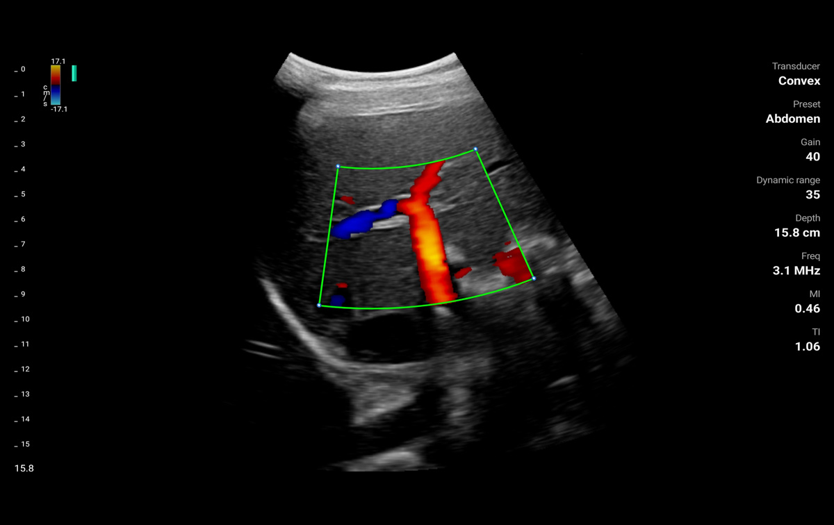 An organ ultrasound image from CF mode