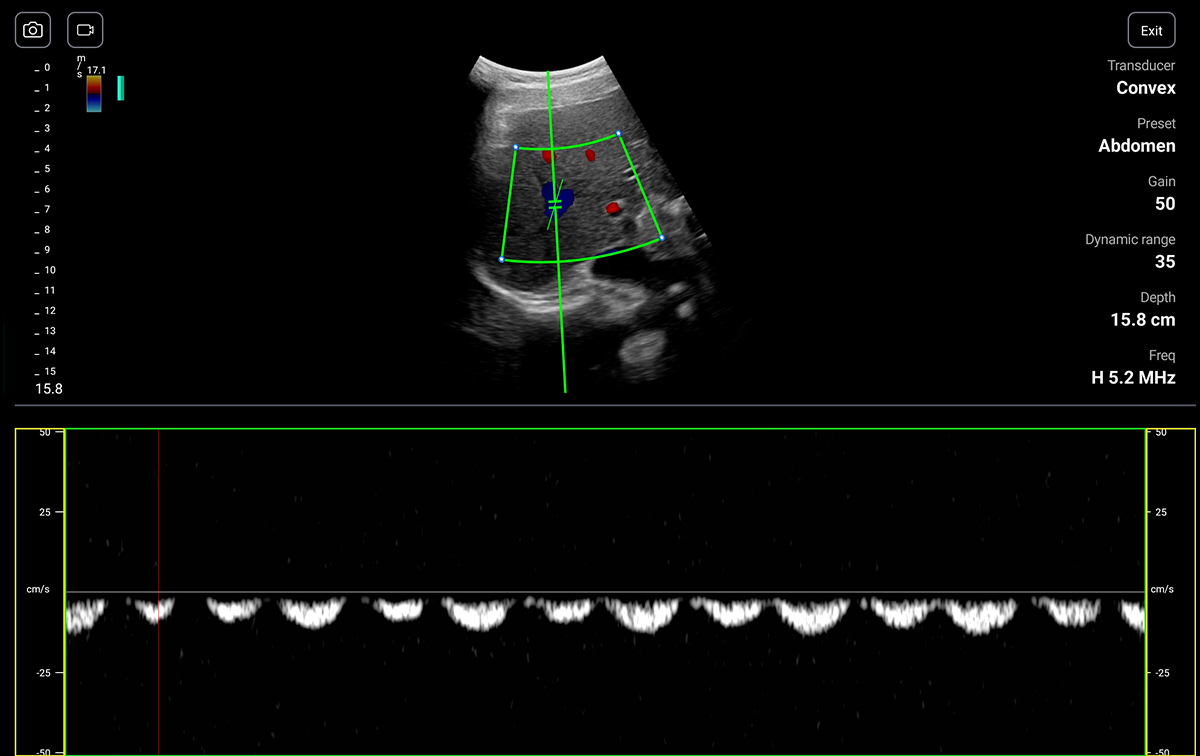 An organ ultrasound image from PW mode