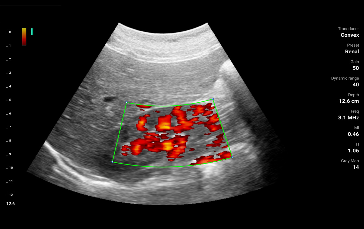 An organ ultrasound image from PD mode