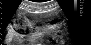 Polysystic ovary syndrome with follicles