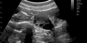 Polysystic ovary syndrome with follicles2
