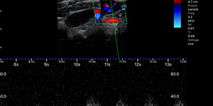 Post-vaccination axillary lymph node hyperplasia, pulse wave