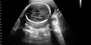 Fetus,-24wk