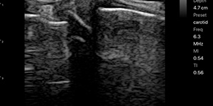 Knee (DJD with femoral spur, buldging of medial meniscus)