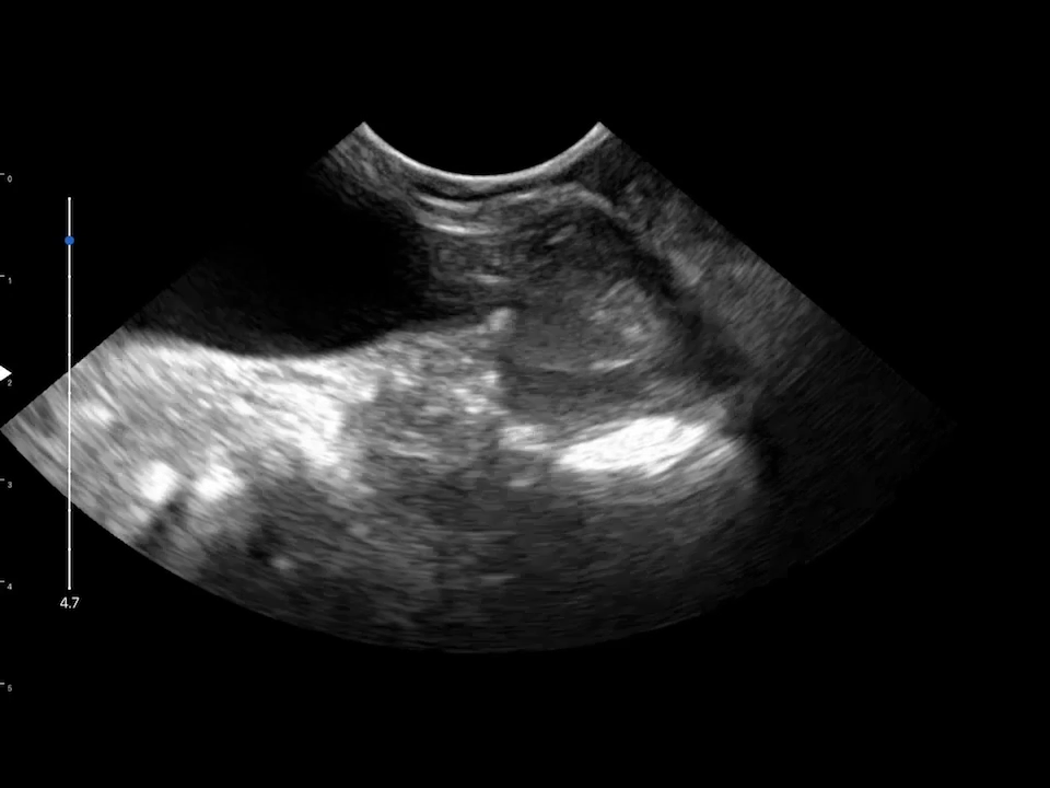 LU800 Maltese_Cystoscopy and Lithotripsy with ultrasound assistance ultrasound image