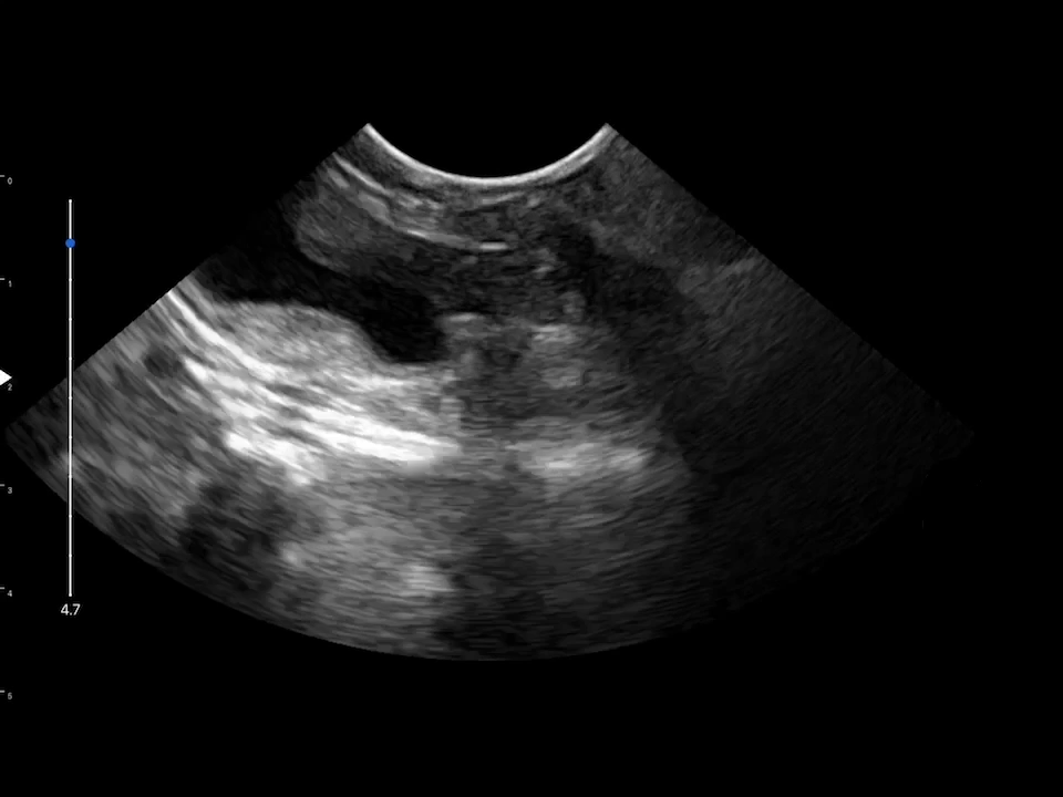 LU800 Maltese_Cystoscopy and Lithotripsy with ultrasound assistance_2 ultrasound image
