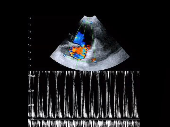 LU800 Maltese_Mitral Regurgitation_Left Atrial Ventricular Dilation_PW mode ultrasound image
