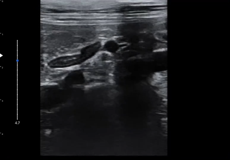 LU800 Prostate_Liver ultrasound image