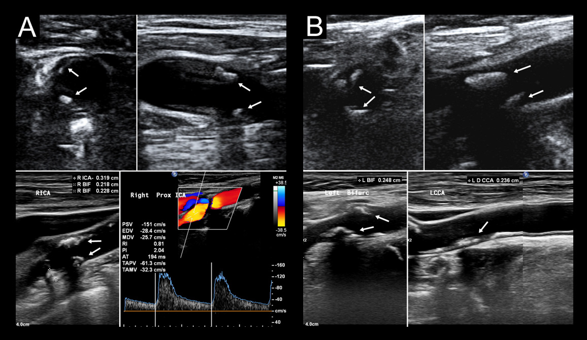 Publication and Paper - Validity and Reliability of Point-of-Care Ultrasound for Detecting Moderate- or High-Grade Carotid Atherosclerosis in an Outpatient Departmen