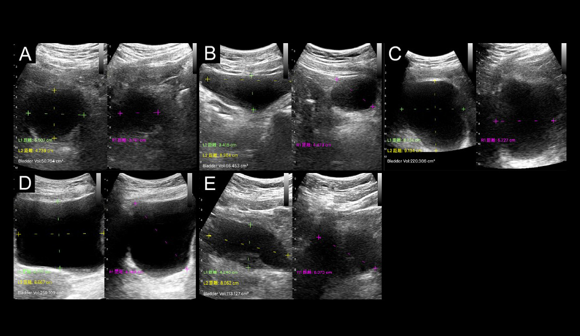 Publication and Paper - Comparative Effectiveness of Two Models of Point-of-Care Ultrasound for Detection of Post-Void Residual Urine during Acute Ischemic Stroke: Preliminary Findings of Real-World Clinical Application